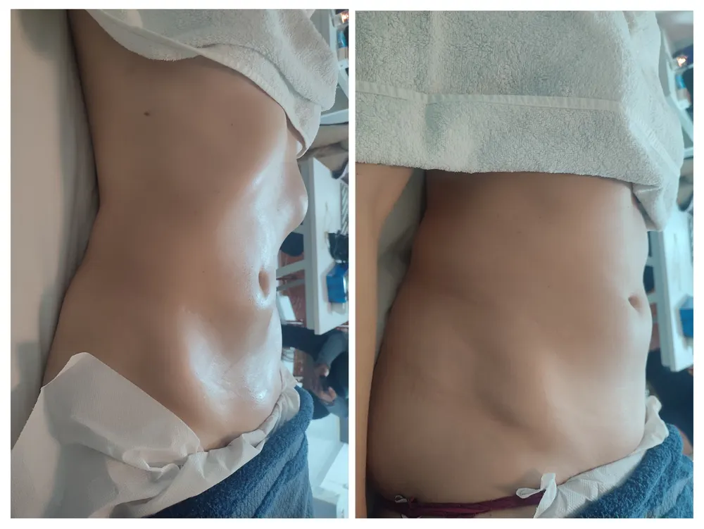 Resultado antes e depois - terapia descongestionante do trato gastrointestinal
