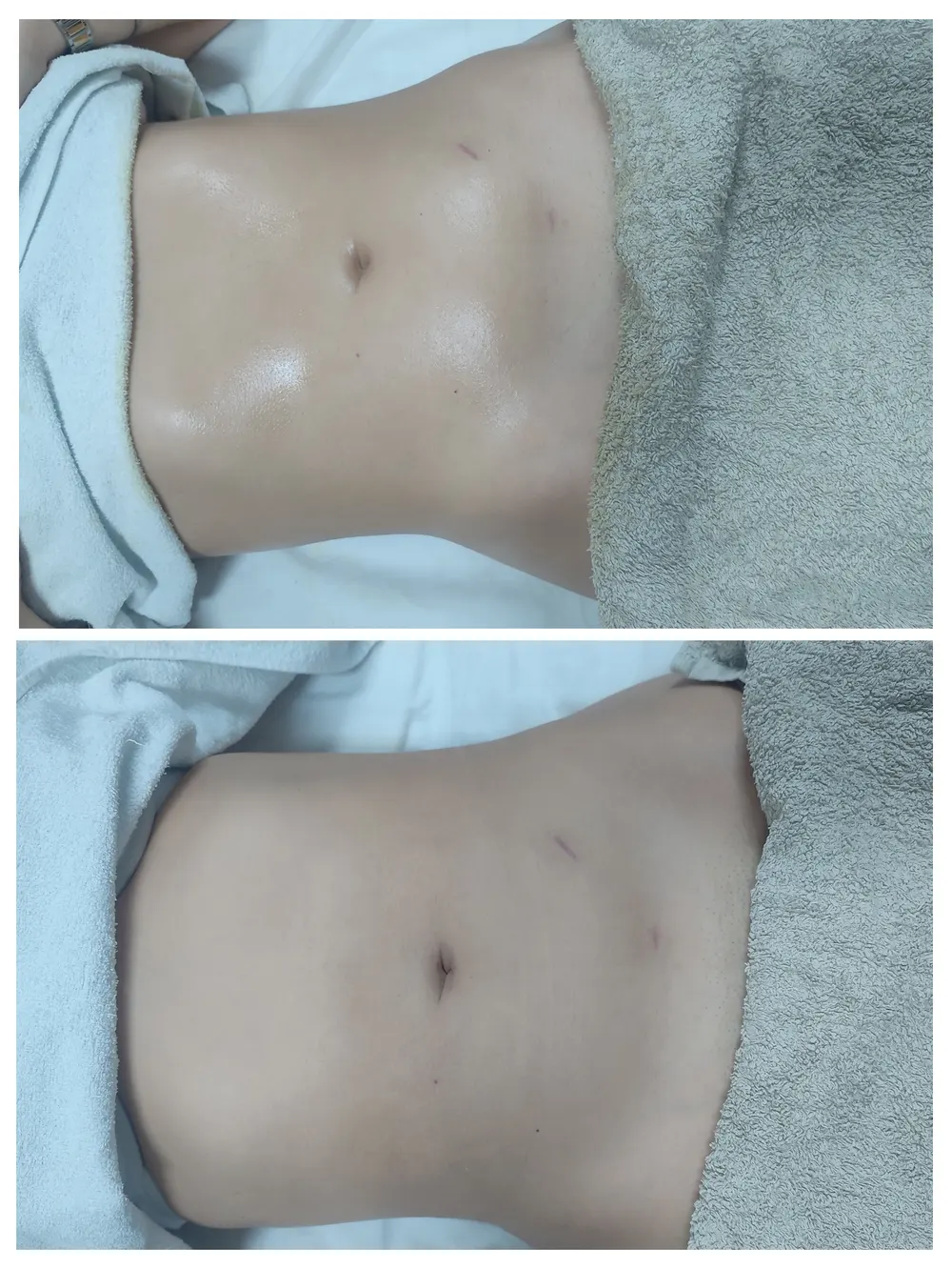 Resultado antes e depois - terapia descongestionante do trato gastrointestinal
