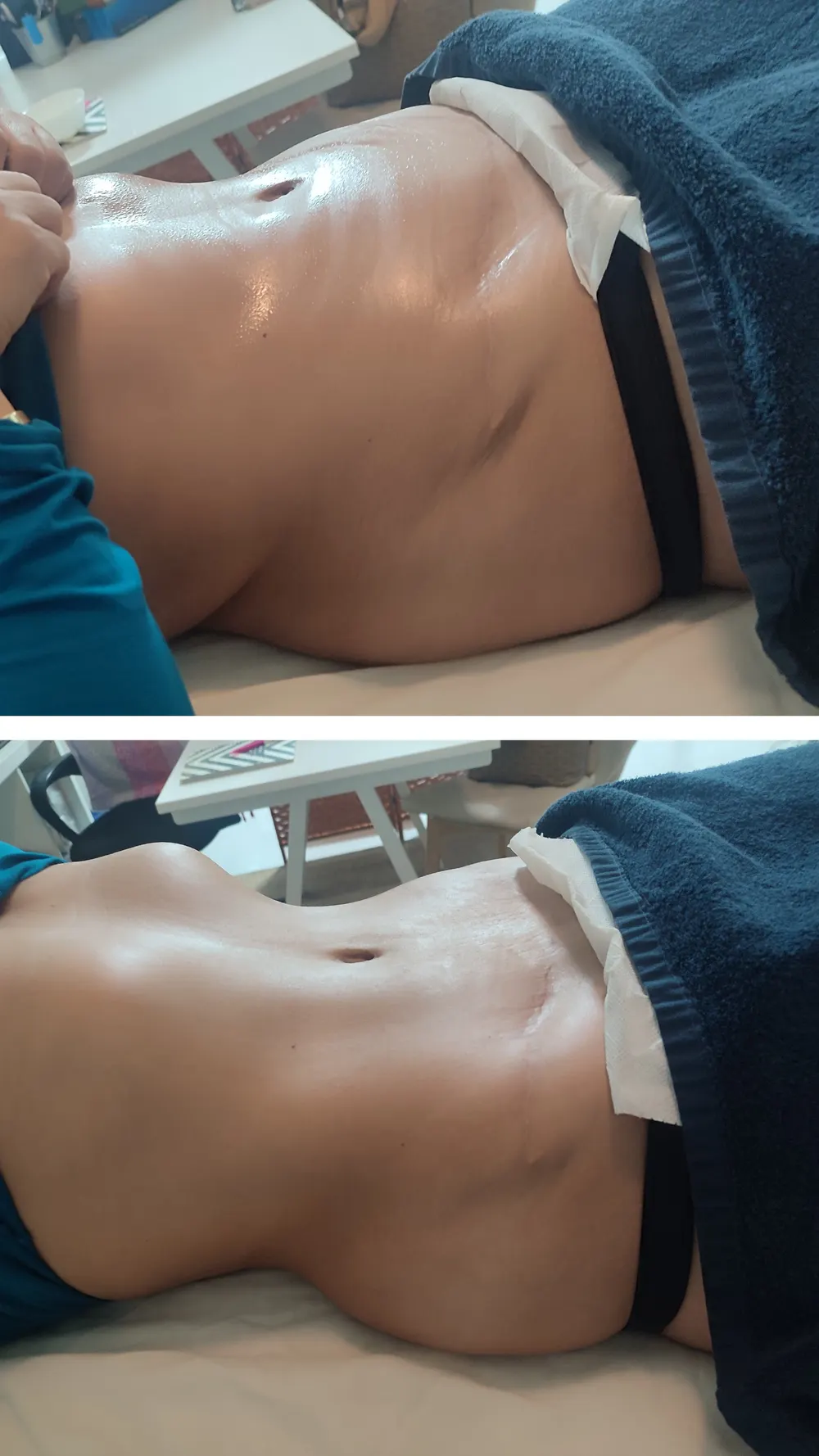 Resultado antes e depois - terapia descongestionante do trato gastrointestinal