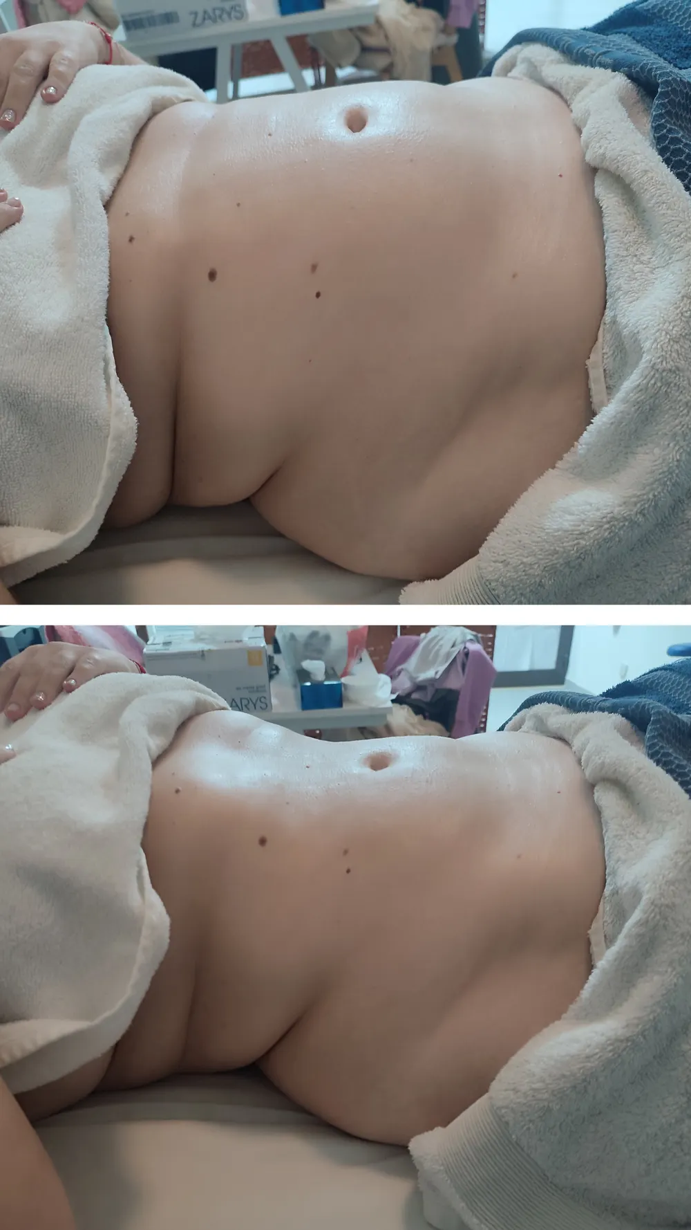 Resultado antes e depois - terapia descongestionante do trato gastrointestinal