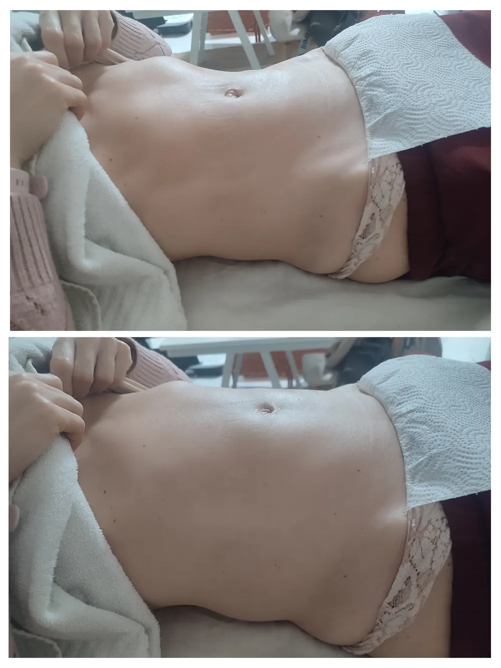 Resultado antes e depois - terapia descongestionante do trato gastrointestinal