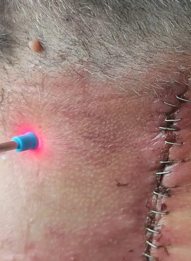 Laserterapia