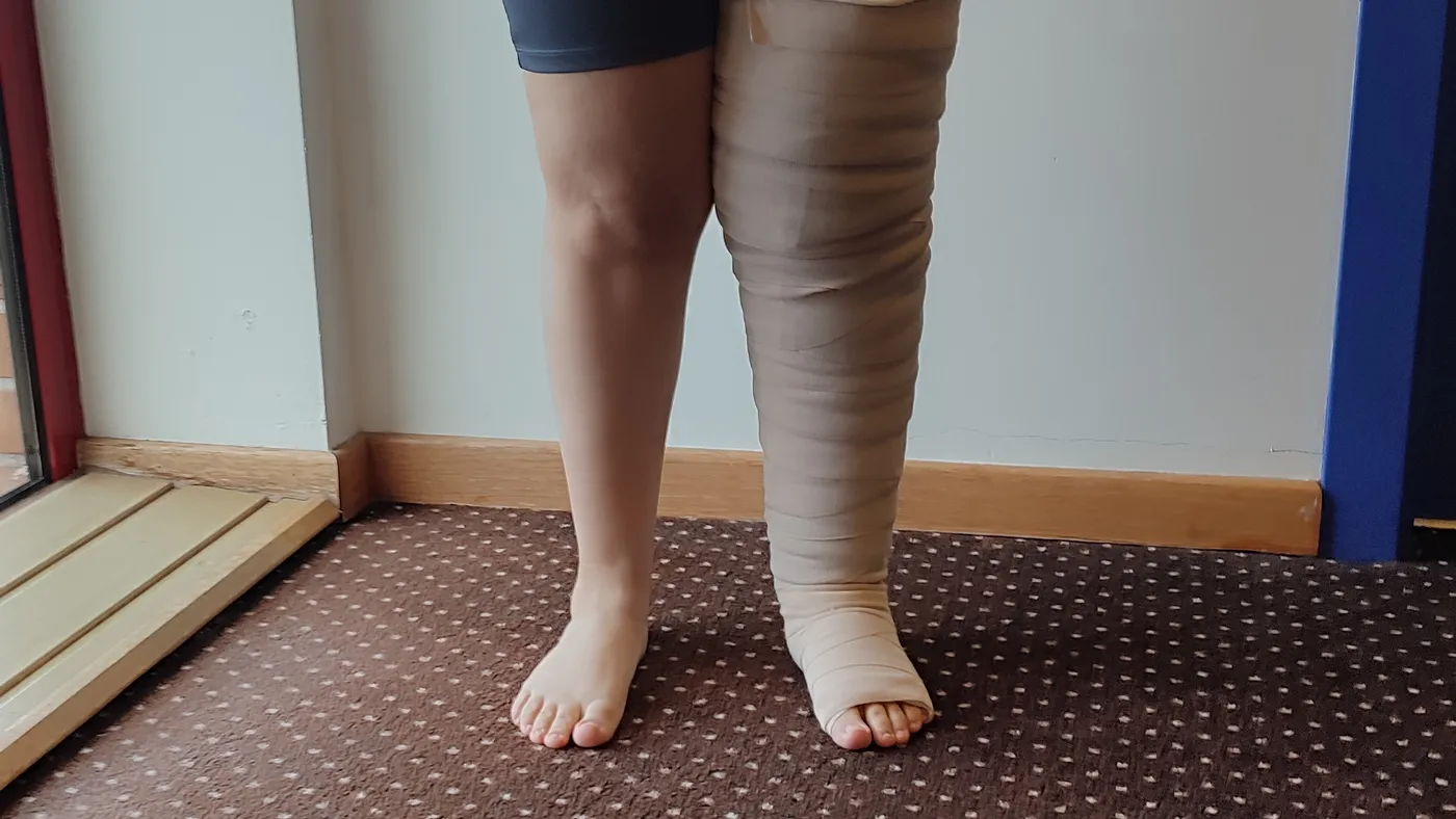 Tratamento de linfedema