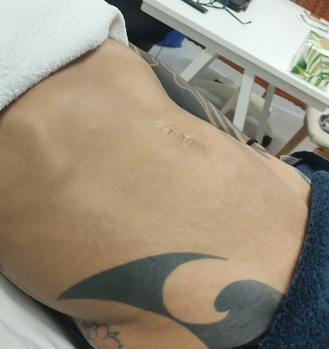 Exclusive lipedema protocol