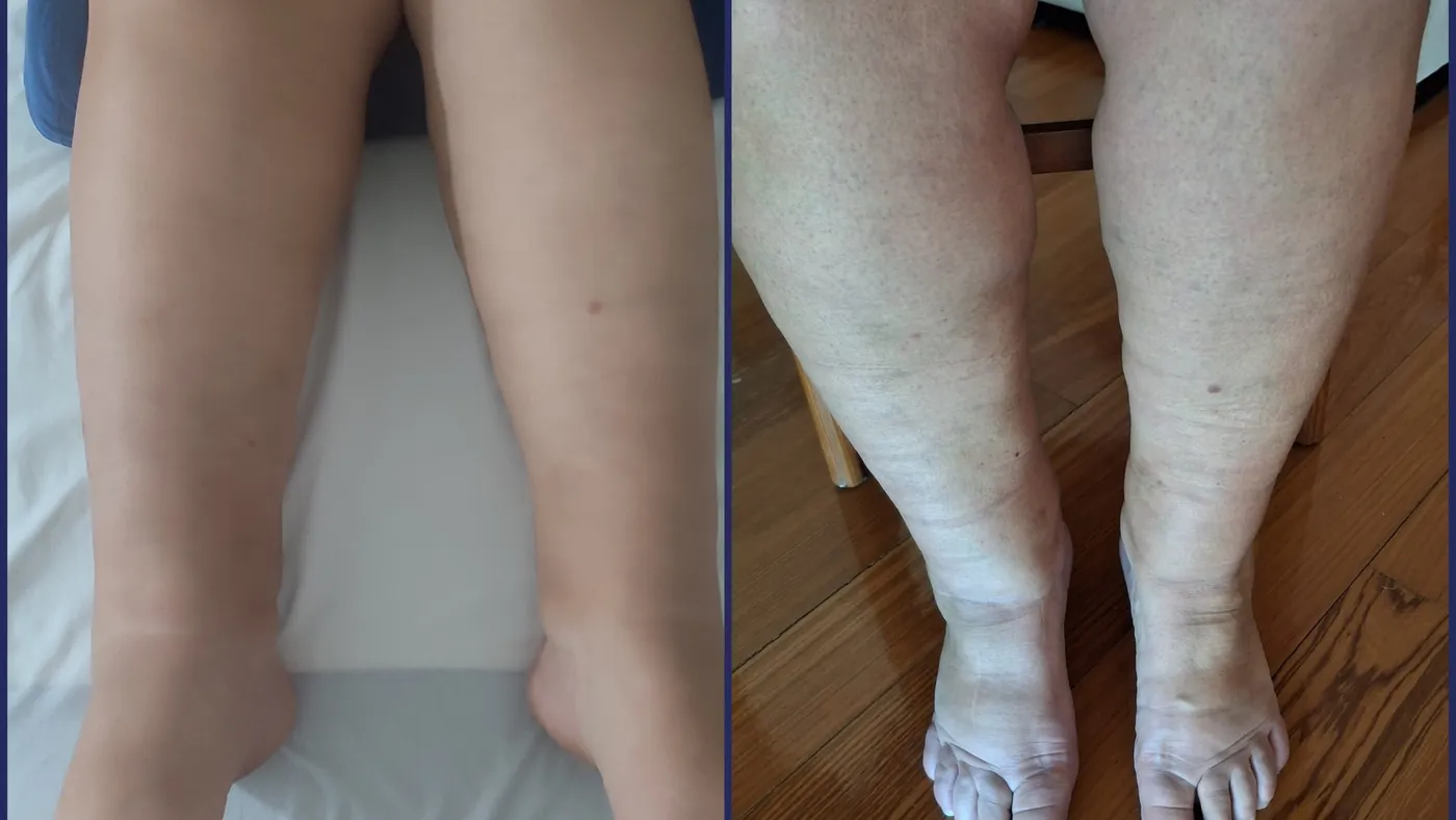 Programa Descomplica Lipedema