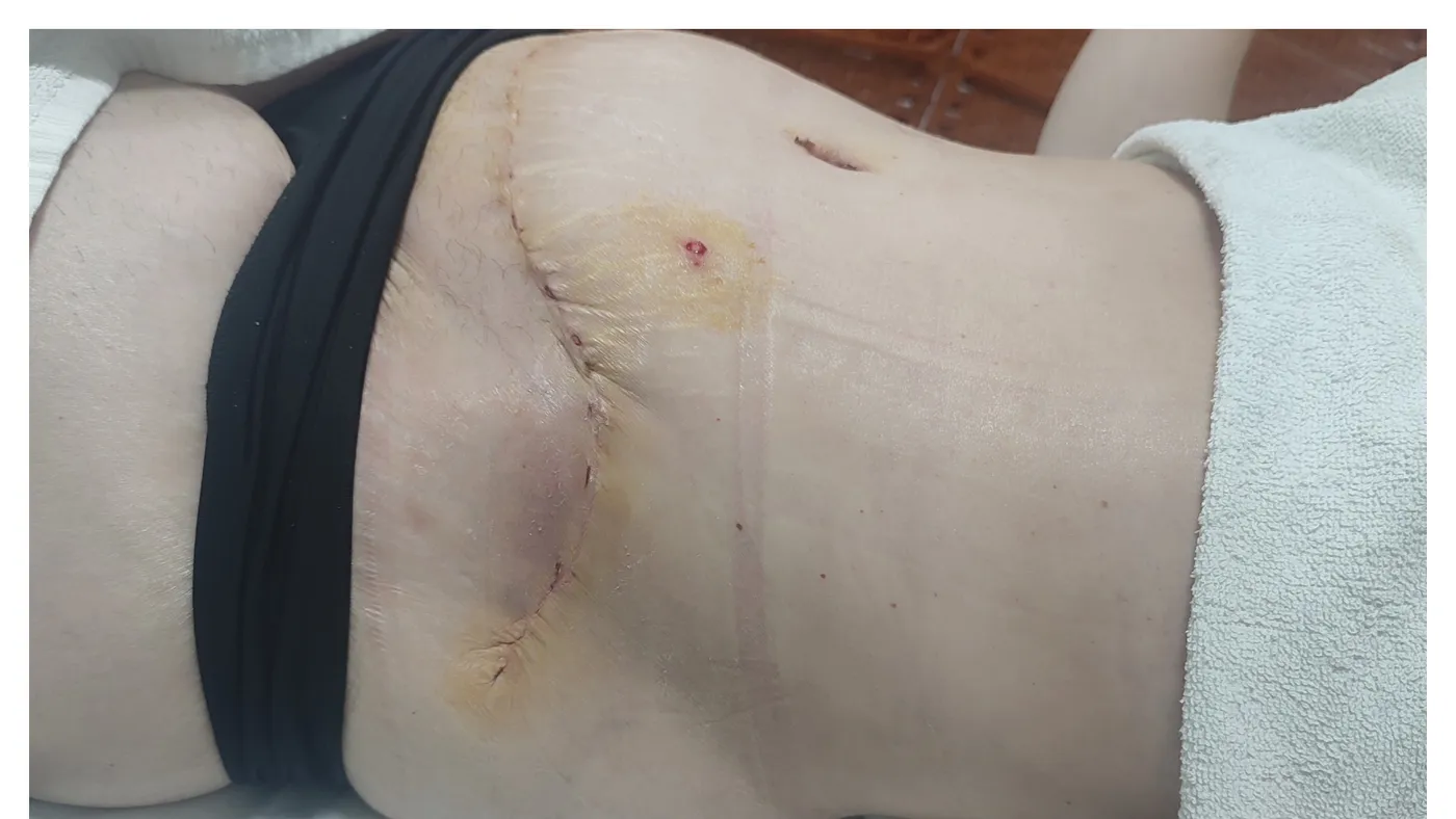 Fisioterapia pós-operatória